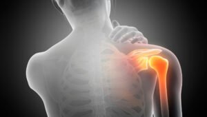 Tendinite no Ombro