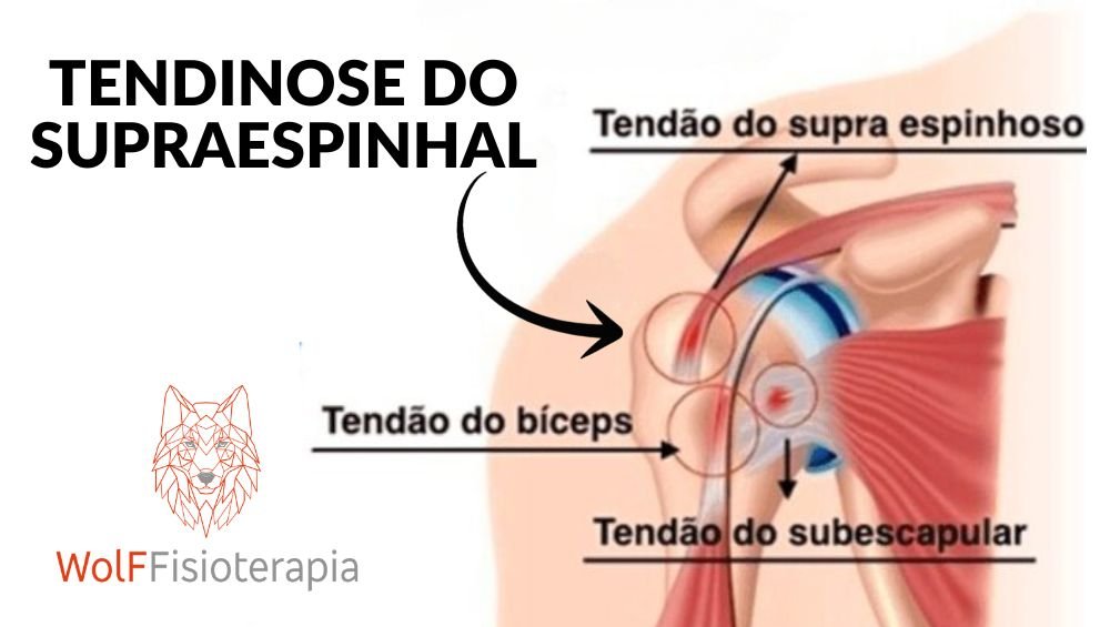 Tendinose do supraespinhal