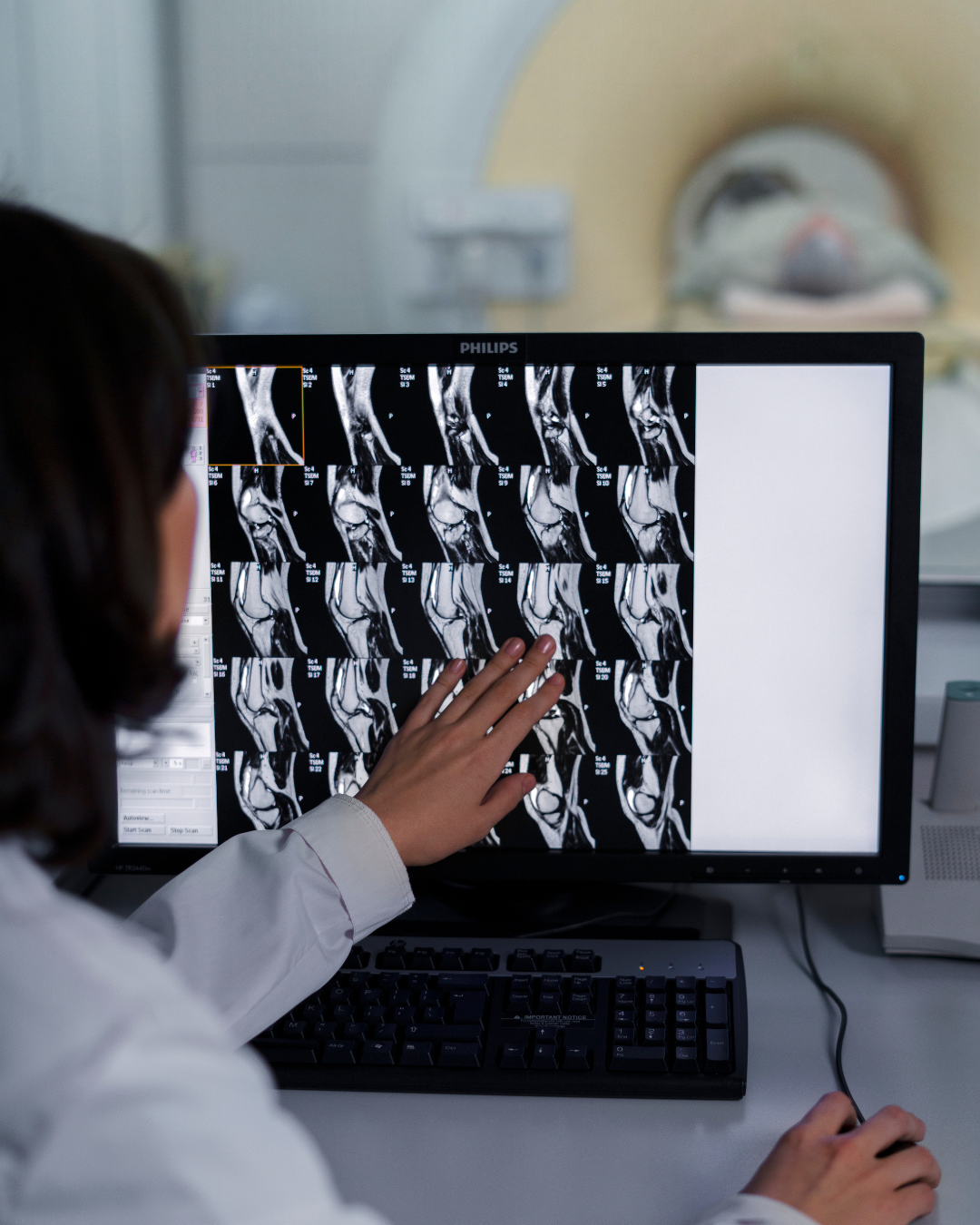 Lesão do menisco medial.